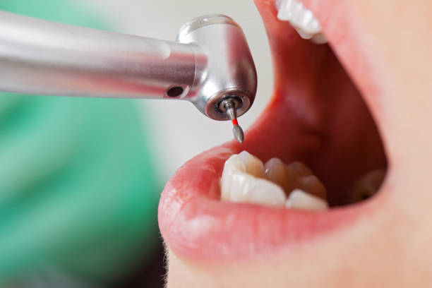 Best Emergency Wisdom Tooth Extraction in Colusa, CA